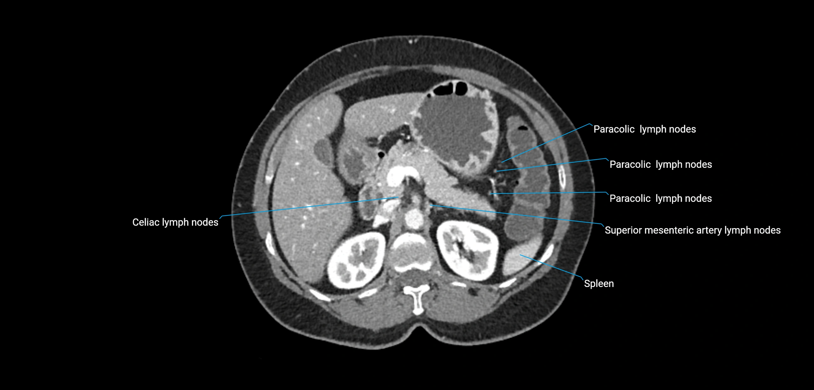 CT ct abdominal lymph nodes  axial cross sectional anatomy  enchanced radiology image -img-00002-00156.webp